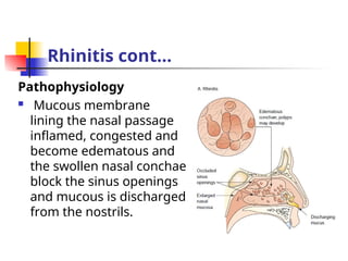 Concha Rhinitis ear, nose and throat disorders best last edited.ppt