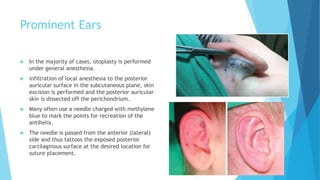 Ear Reconstruction_084051.pptx