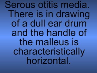 Serous otitis media.
 There is in drawing
  of a dull ear drum
  and the handle of
    the malleus is
  characteristically
      horizontal.
 