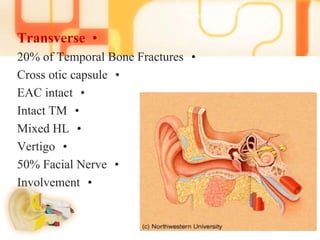 •Transverse
•20% of Temporal Bone Fractures
•Cross otic capsule
•EAC intact
•Intact TM
•Mixed HL
•Vertigo
•50% Facial Nerve
•Involvement
 