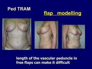 Ped TRAM  flap  modelling length of the vascular peduncle in  free flaps can make it difficult  