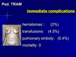 Ped. TRAM  immediate complications hematomas :  (2%) transfusions:  (4.5%)  pulmonary emboly:  (0.4%) mortality  0   