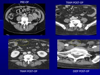 PRE-OP DIEP POST-OP TRAM POST-OP TRAM POST-OP 