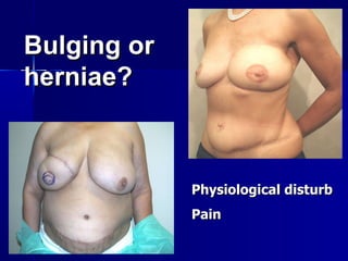 Bulging or herniae? Physiological disturb  Pain  