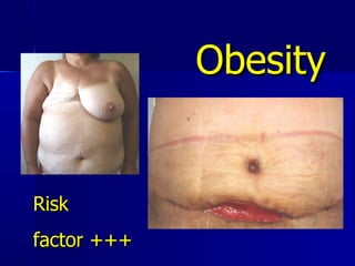 Obesity Risk  factor +++ 