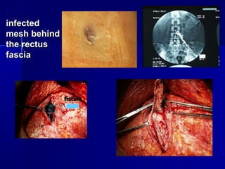 Fistula with  infected  mesh behind the rectus fascia fistula 