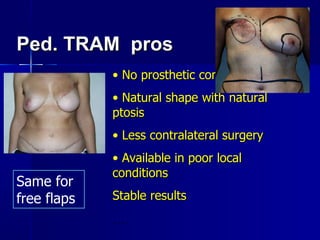 Ped. TRAM  pros   No prosthetic complications Natural shape with natural ptosis Less contralateral surgery  Available in poor local conditions Stable results ....  Same for free flaps 