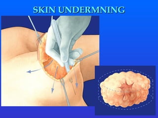 SKIN UNDERMNING 