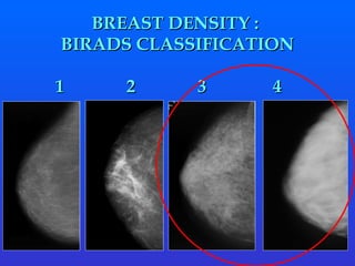 BREAST DENSITY :  BIRADS CLASSIFICATION 1  2  3  4  