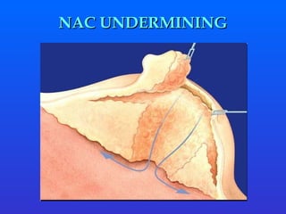 NAC UNDERMINING 