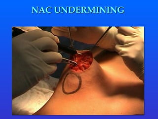 NAC UNDERMINING  