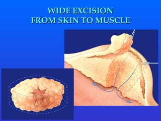 WIDE EXCISION FROM SKIN TO MUSCLE 