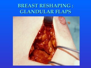 BREAST RESHAPING : GLANDULAR FLAPS 