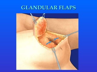 GLANDULAR FLAPS 