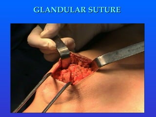 GLANDULAR SUTURE  