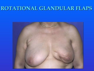 ROTATIONAL GLANDULAR FLAPS 