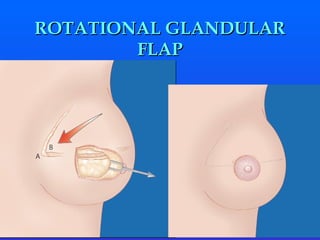 ROTATIONAL GLANDULAR FLAP 