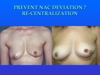 PREVENT NAC DEVIATION ?   RE-CENTRALIZATION  