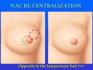 NAC RE-CENTRALIZATION  Opposite to the lumpectomy bed +++ 