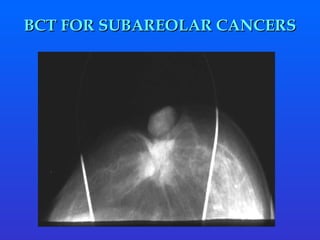 BCT FOR SUBAREOLAR CANCERS 