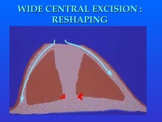 WIDE CENTRAL EXCISION :  RESHAPING  