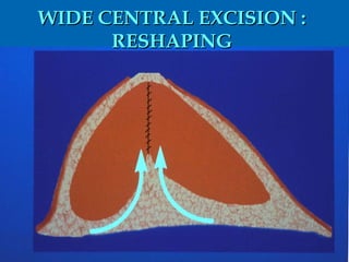 WIDE CENTRAL EXCISION :  RESHAPING  