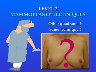" LEVEL 2 " MAMMOPLASTY TECHNIQUES Other quadrants ?  Same technique ? ?  