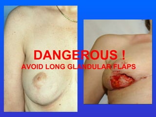 DANGEROUS ! AVOID LONG GLANDULAR FLAPS  