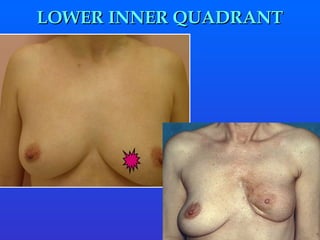 LOWER INNER QUADRANT 