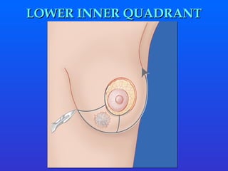 LOWER INNER QUADRANT 