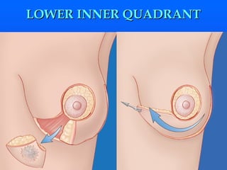 LOWER INNER QUADRANT 