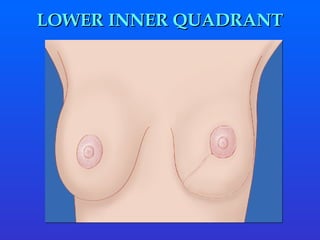 LOWER INNER QUADRANT 