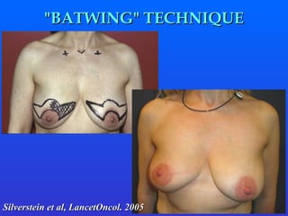 " BATWING "  TECHNIQUE Silverstein et al, LancetOncol. 2005  