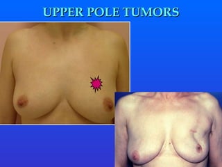 UPPER POLE TUMORS 