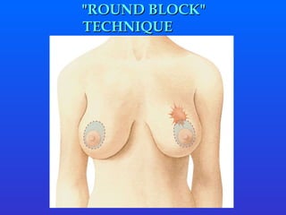   " ROUND BLOCK "  TECHNIQUE 