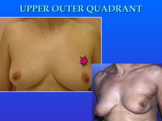 UPPER OUTER QUADRANT 
