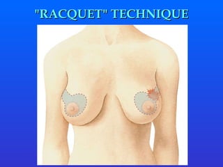 " RACQUET "  TECHNIQUE 