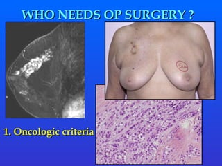 1. Oncologic criteria WHO NEEDS OP SURGERY ?  