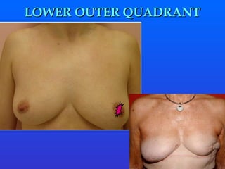 LOWER OUTER QUADRANT 