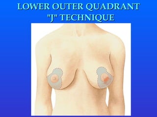    "J"  TECHNIQUE LOWER OUTER QUADRANT 