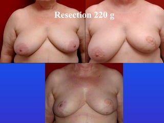 Resection 220 g  