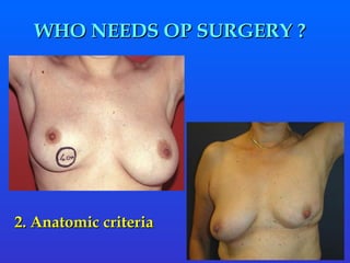 WHO NEEDS OP SURGERY ?  2. Anatomic criteria 
