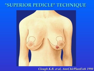 " SUPERIOR PEDICLE "  TECHNIQUE Clough K.B. et al, AnnChirPlastEsth 1990  