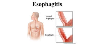 Esophagitis
 