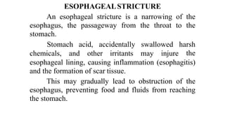 ESOPHAGEALSTRICTURE


An esophageal stricture is a narrowing of the
esophagus, the passageway from the throat to the
stomach.
chemicals,
	
and
	
other
	
irritants
	
may
	
injure
Stomach
	
acid,
	
accidentally
	
swallowed
	
harsh


the
esophageal lining, causing inflammation (esophagitis)
and the formation of scar tissue.


This may gradually lead to obstruction of the
esophagus, preventing food and fluids from reaching
the stomach.
 