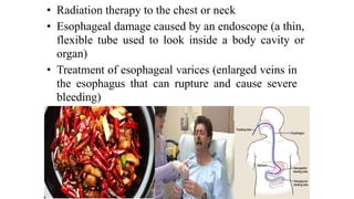 • Radiation therapy to the chest or neck


• Esophageal damage caused by an endoscope (a thin,
flexible tube used to look inside a body cavity or
organ)


• Treatment of esophageal varices (enlarged veins in
the esophagus that can rupture and cause severe
bleeding)
 