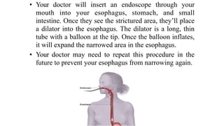 • Your doctor will insert an endoscope through your
mouth into your esophagus, stomach, and small
intestine. Once they see the strictured area, they’ll place
a dilator into the esophagus. The dilator is a long, thin
tube with a balloon at the tip. Once the balloon inflates,
it will expand the narrowed area in the esophagus.


• Your doctor may need to repeat this procedure in the
future to prevent your esophagus from narrowing again.
 