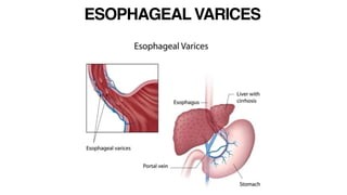 ESOPHAGEAL VARICES
 