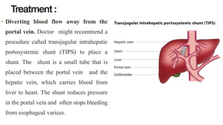 Treatment :
• Diverting blood flow away from the
portal vein. Doctor might recommend a
procedure called transjugular intrahepatic
portosystemic shunt (TIPS) to place a
shunt. The shunt is a small tube that is
placed between the portal vein and the
hepatic vein, which carries blood from
liver to heart. The shunt reduces pressure
in the portal vein and often stops bleeding
from esophageal varices.
 