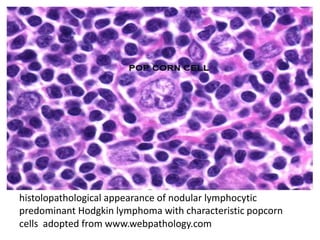 histolopathological appearance of nodular lymphocytic
predominant Hodgkin lymphoma with characteristic popcorn
cells adopted from www.webpathology.com
 